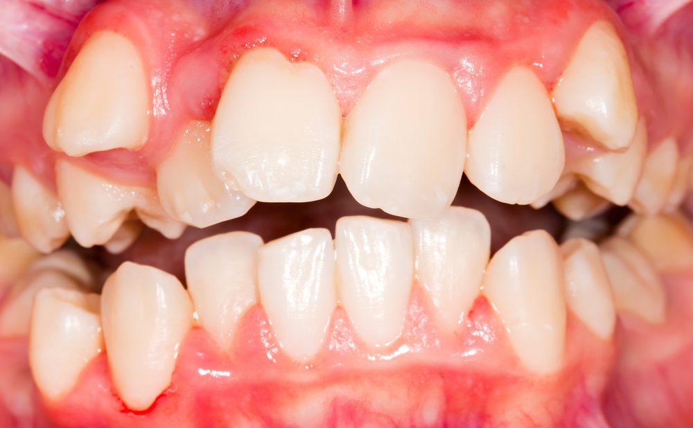 Do you know which cases should be orthodontic treated?