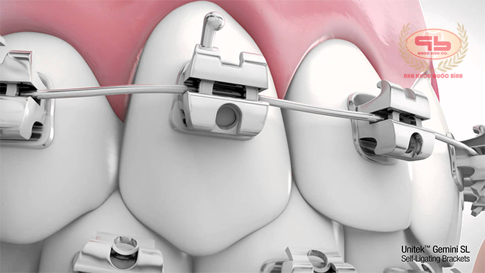 Braces system in orthodontic treatment
