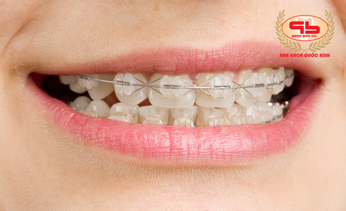 Braces system in orthodontic treatment