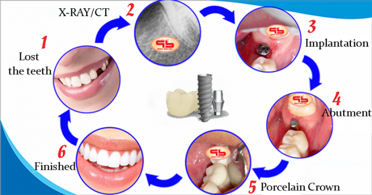 dental-implant-procedures-according-to-international-standards