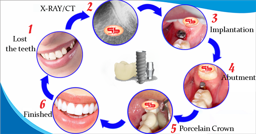 Dental Implant procedures according to international standards