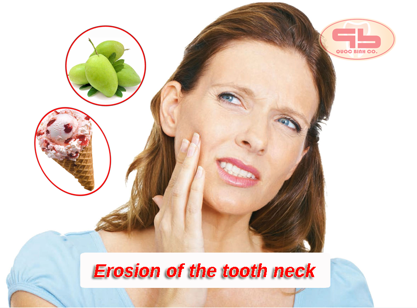 Erosion of the tooth neck