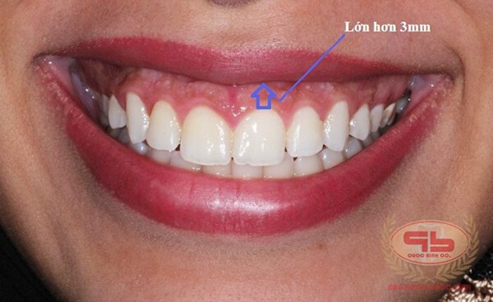 Gummy smile, what treatments are appropriate?