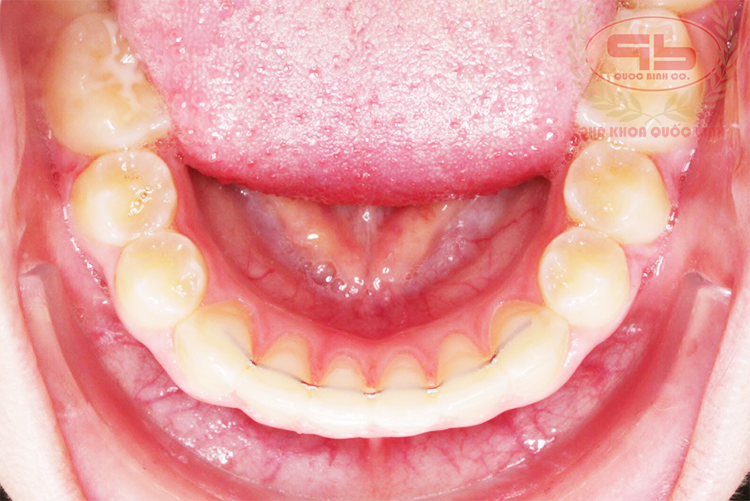 Làm thế nào để răng ngay ngắn mà không cần niềng răng mắc cài?