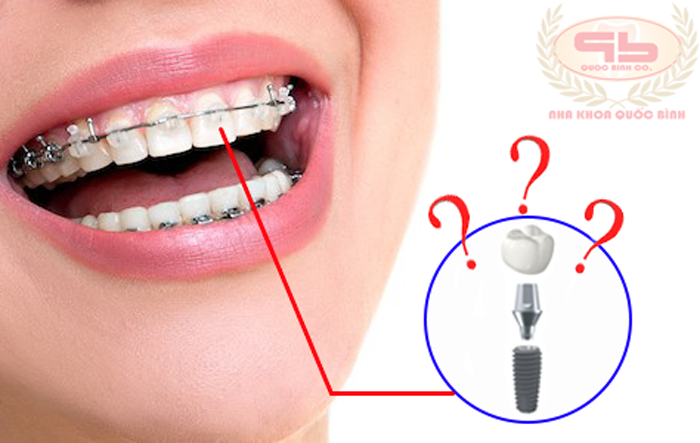 If I had dental implant then can have any braces?