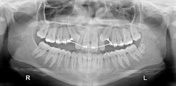 Phẫu thuật bộc lộ răng ngầm trong xương - kéo răng chỉnh nha