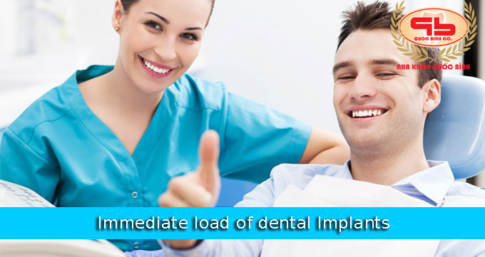 Immediate load of dental Implants