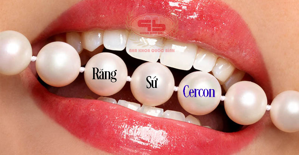 Răng sứ Cercon - tiêu chuẩn thẩm mỹ răng sứ bền đẹp.