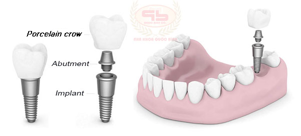 Dental implants integrate bone rapidly