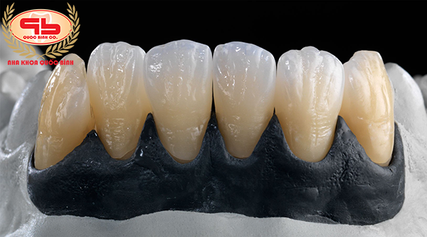 Is Zolid dental porcelain crown suitable you?