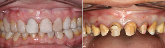 Tỷ lệ mài răng phụ thuộc tình trạng răng