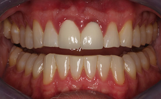 The risk may occur when making cheap dental porcelain crown