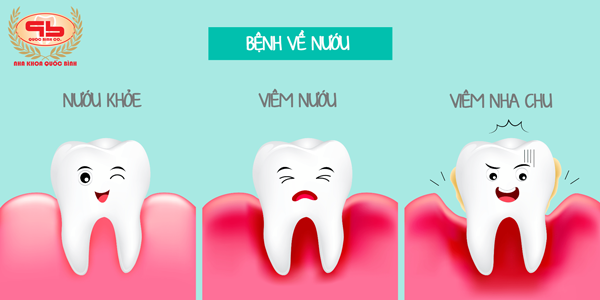 Những dấu hiệu viêm nướu răng dễ nhận biết và cách phòng ngừa.