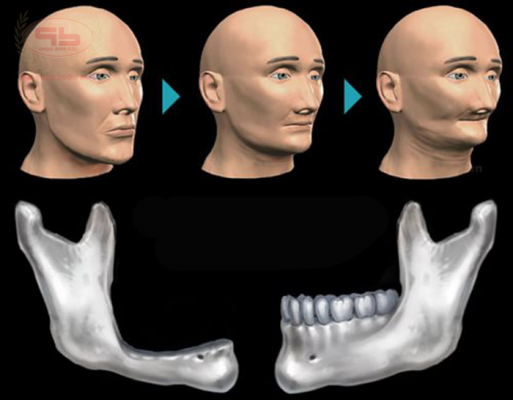 How Long After Teeth Loss Then Jawbone Loss