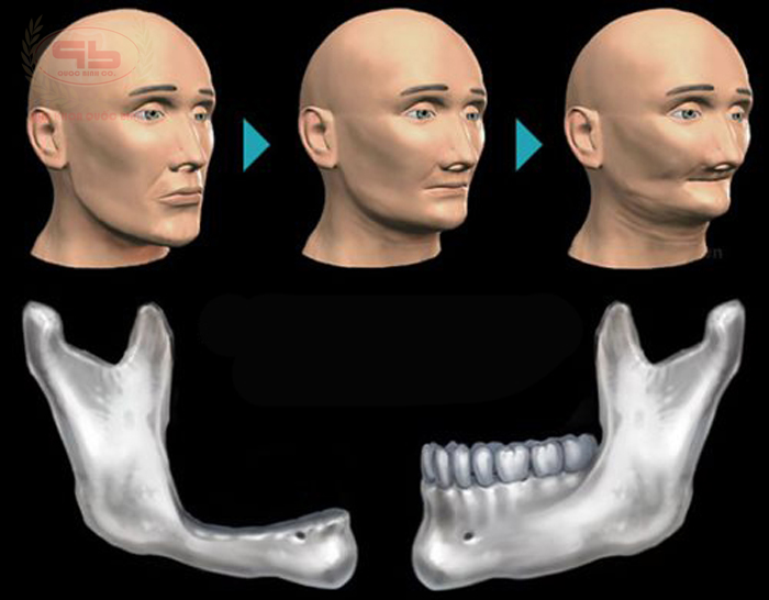 How long after teeth loss then jawbone loss?