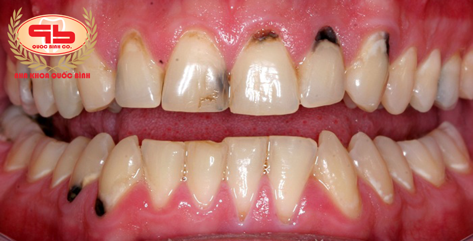Chân răng bị dính nhựa đen làm sao để sạch?