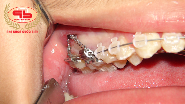 Do you know that minivis can help shorten the period of treatment in orthodontics?