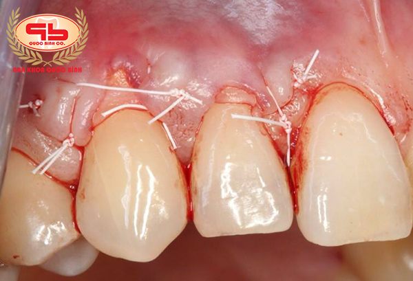 Gingival graft surgery to treat gums recession to expose the tooth's neck