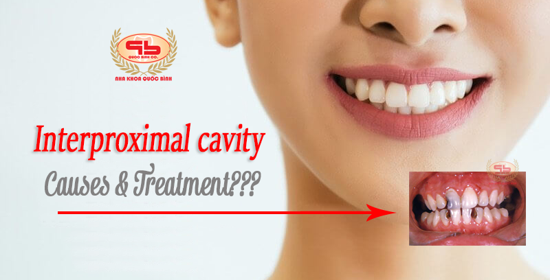 Causes of an interproximal cavity, and how is effective treatment?
