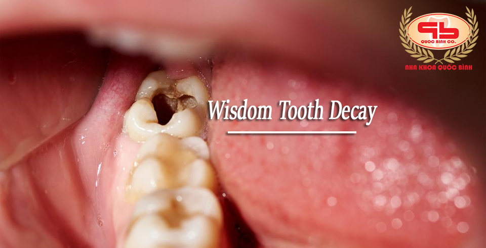 What to do when having a wisdom tooth decay?