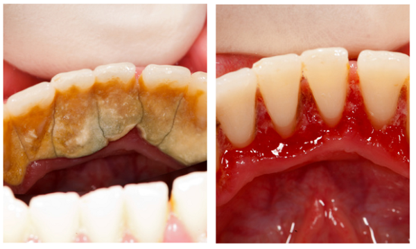 Too thick tartar contributes to receding gums, and bleeding gums