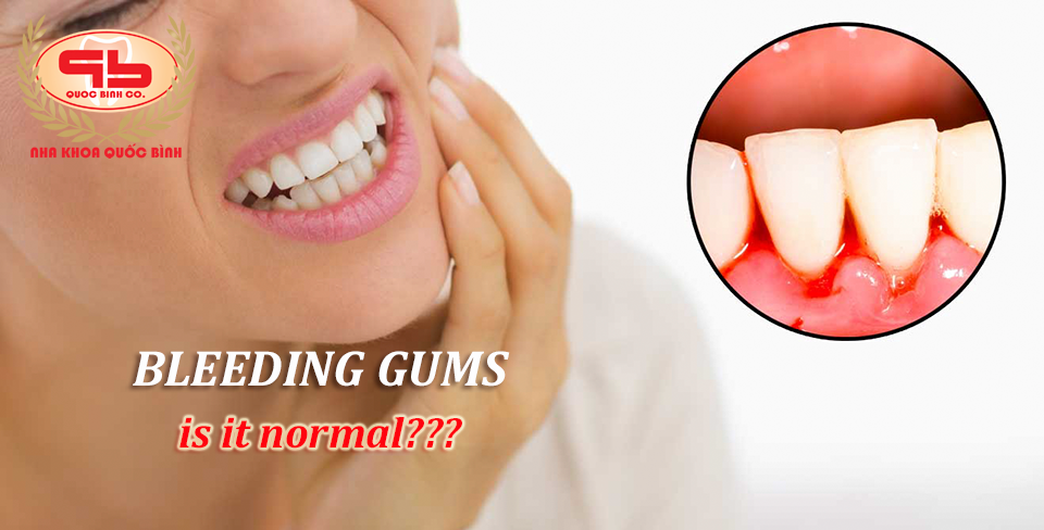 Bleeding gums, is it normal?