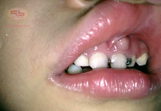 Bạn biết gì về bệnh lý viêm quanh cuống răng?