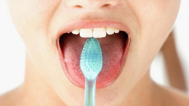 Mặt lưỡi tụ tập vi khuẩn gây chứng hôi miệng