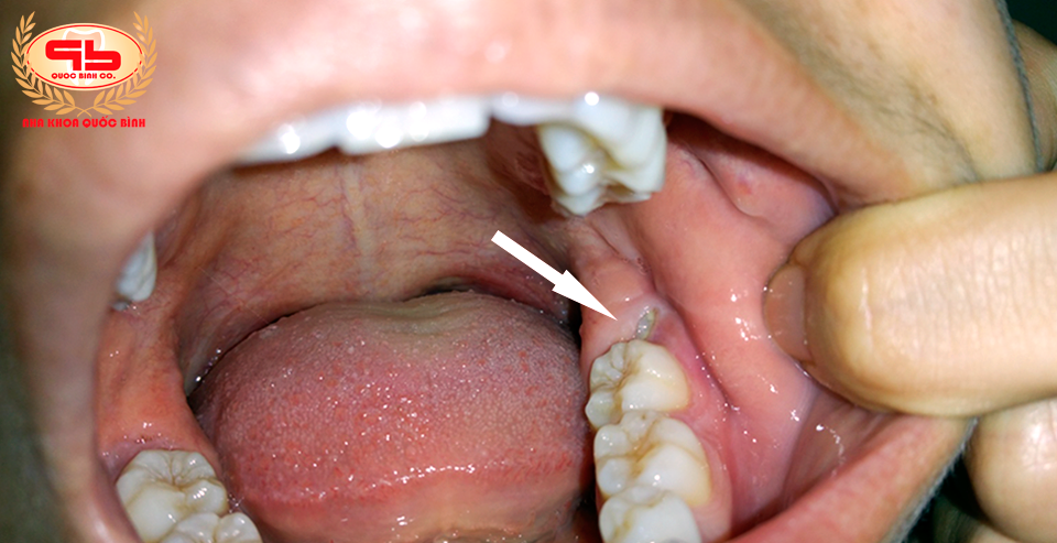 What To Do To Reduce Pain Quickly When Wisdom Teeth Growing 