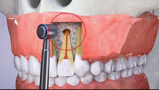 Phẫu thuật cắt chóp răng trong điều trị viêm quanh cuống răng