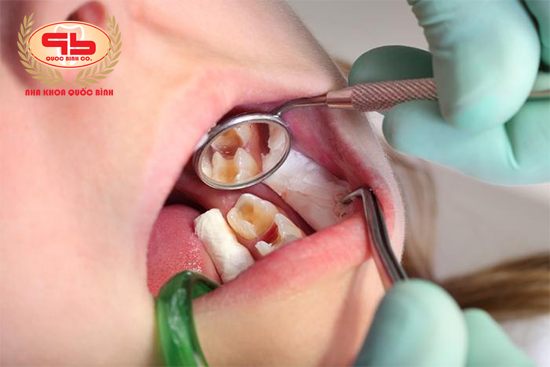 Is it really necessary to treat milk teeth pulp in children??