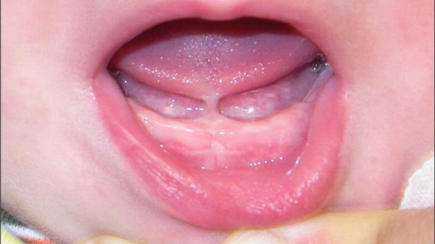 Things to know when children have tongue tie condition