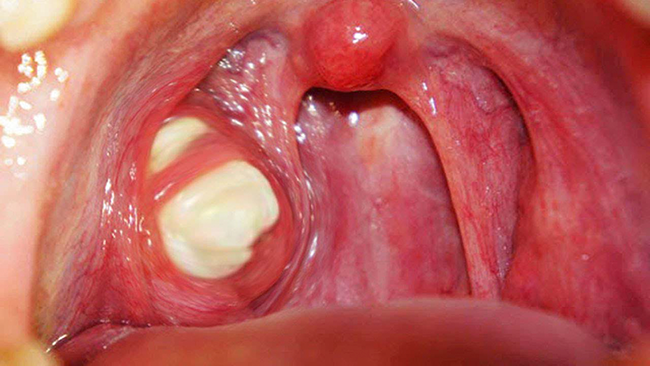 Purulent tonsillitis produces tonsil stones with a terrible smell, which make the bad breath