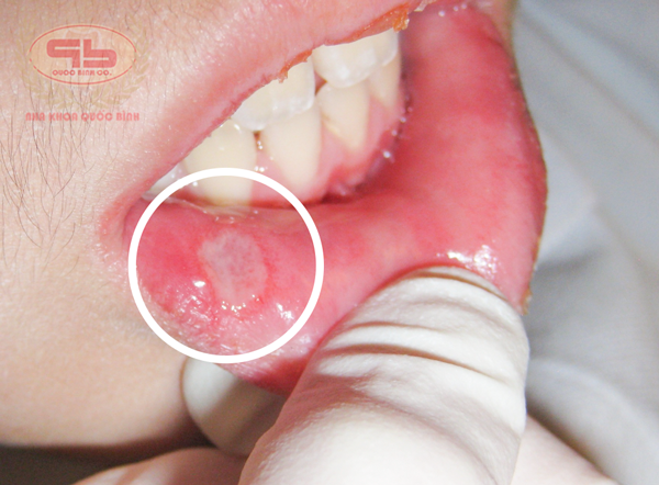 Aphthous stomatitis causes pain and discomfort in the mouth