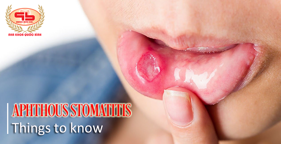 Aphthous stomatitis - things you should know