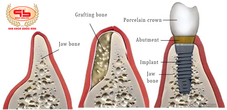 Grafting bone helps dental Implant is steady