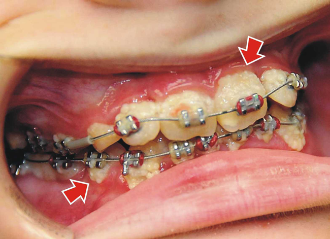 Poor oral hygiene during braces will increase the risk of weakening real teeth.