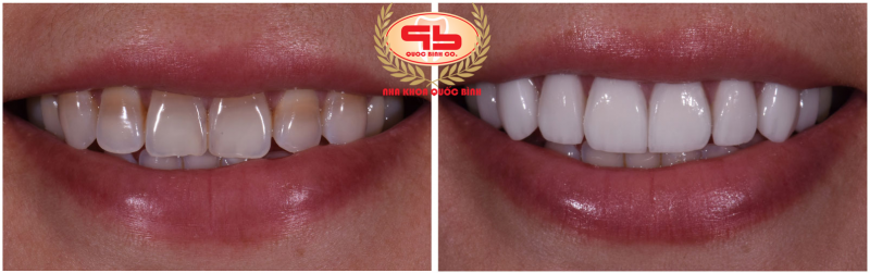 Porcelain crown help conceal the color of the stained teeth very well