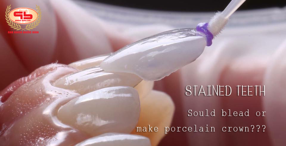 Stained teeth should bleach or make porcelain crown??