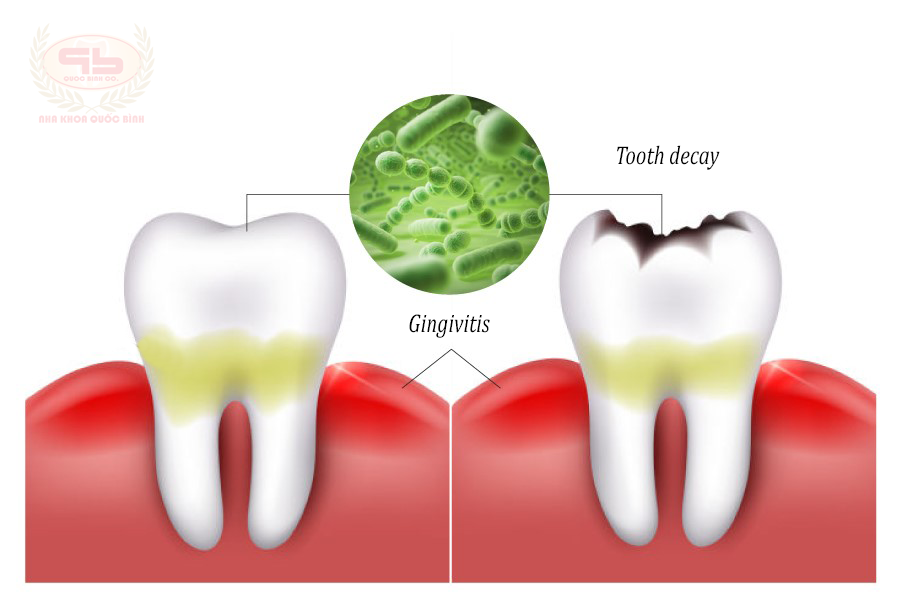 Dangerous complications from tooth decay cause serious health effects.