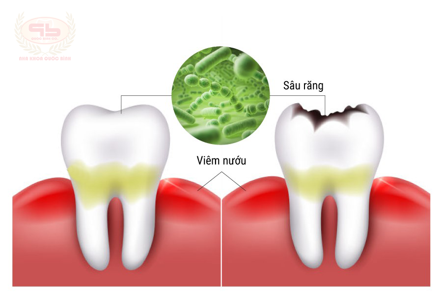 Những biến chứng nguy hại từ sâu răng làm ảnh hưởng sức khỏe nghiêm trọng