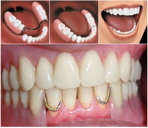 Removable dentures replace real teeth when shortage of permanent teeth