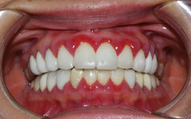 What causes pain under a crowned tooth?