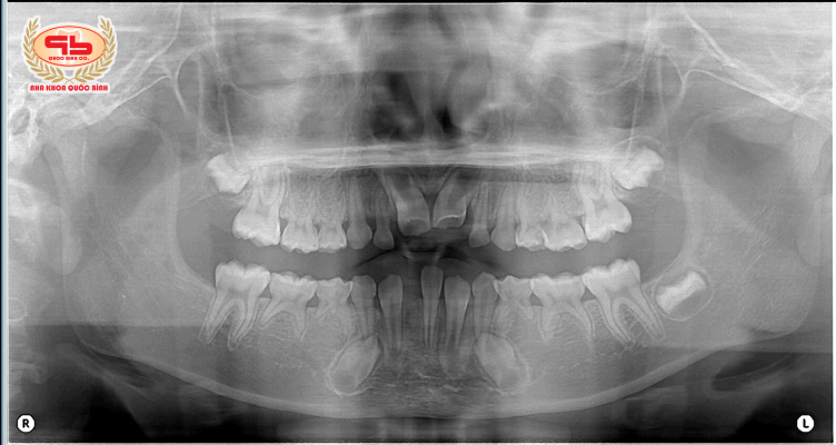 Thiếu răng vĩnh viễn do không có mầm răng