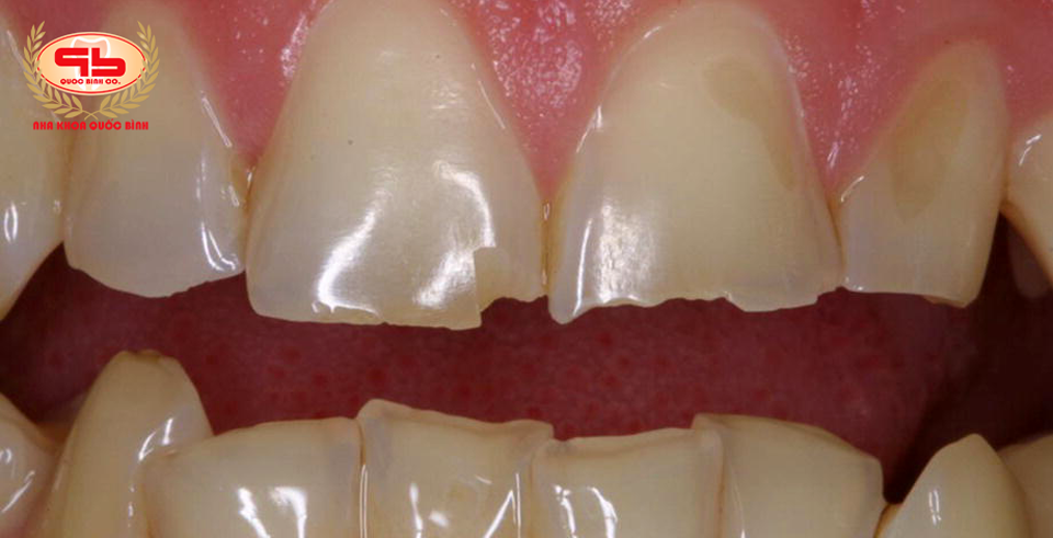 Men răng hư tổn có phục hồi được không?