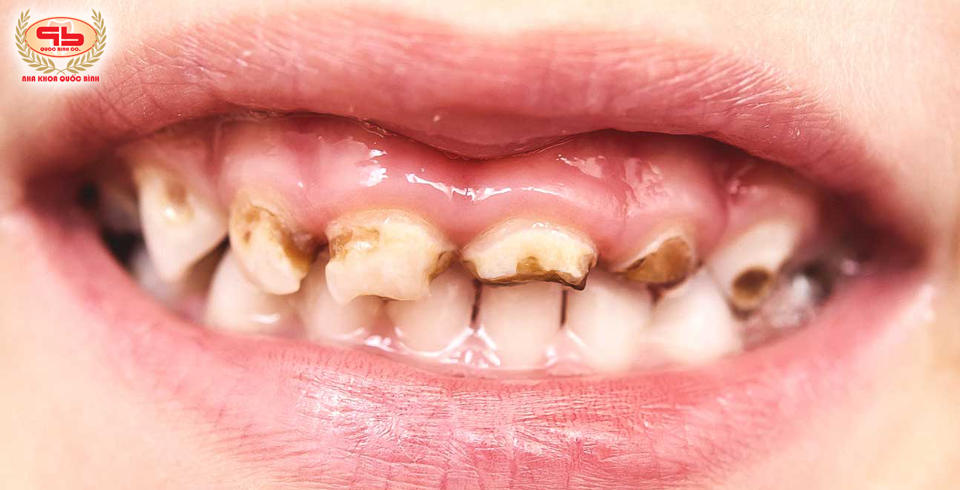 Milk tooth decay in children is worrying?