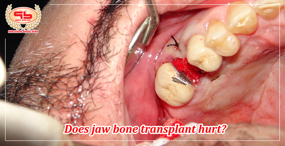 So does jaw bone transplant hurt?