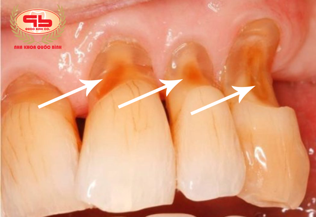 Broken incisors due to worn the tooth
