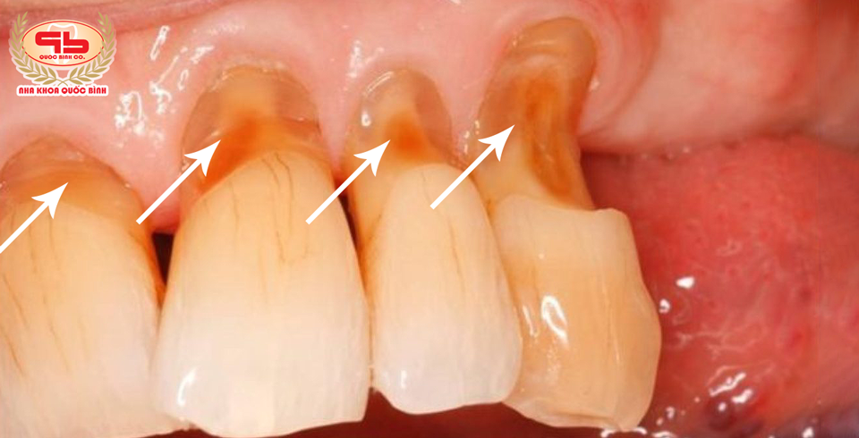 What are the reasons for tooth wear? Is it because of eating too much?