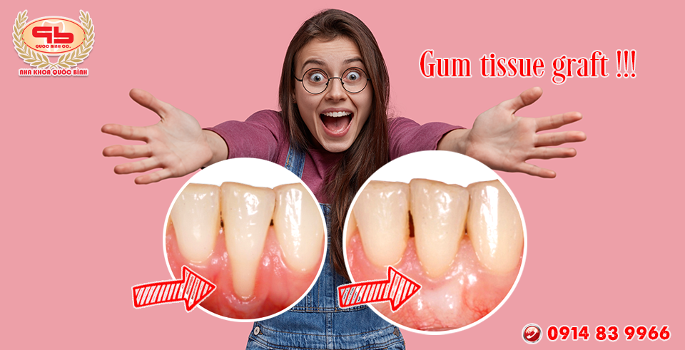 Should you worry when your doctor asks you to have a gum tissue graft?